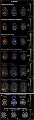 Peripheral Nervous System Reconstruction Reroutes Cortical Motor Output—Brain Reorganization Uncovered by Effective Connectivity
